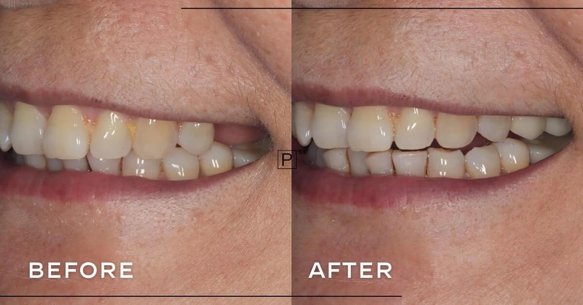 Susan of Pymble’s Dental Implant Makeover Gallery image