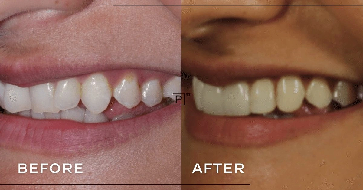 Trish of CBD’s Invisalign Makeover Gallery image