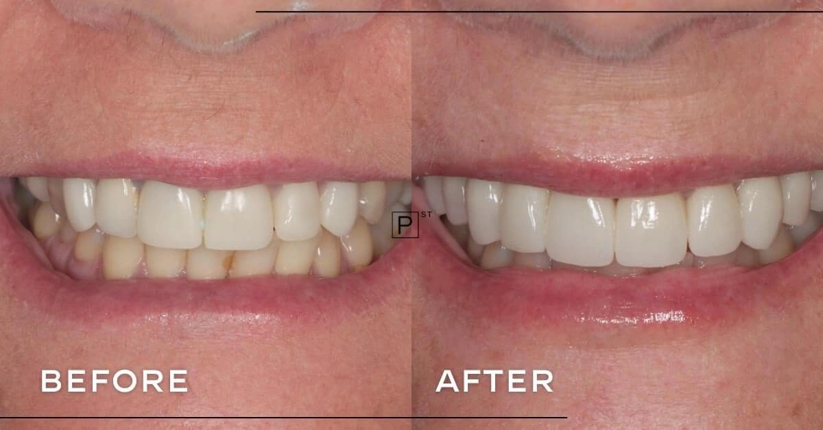 Vicky of Parramatta’s Dental Implant and Crown Makeover Gallery image
