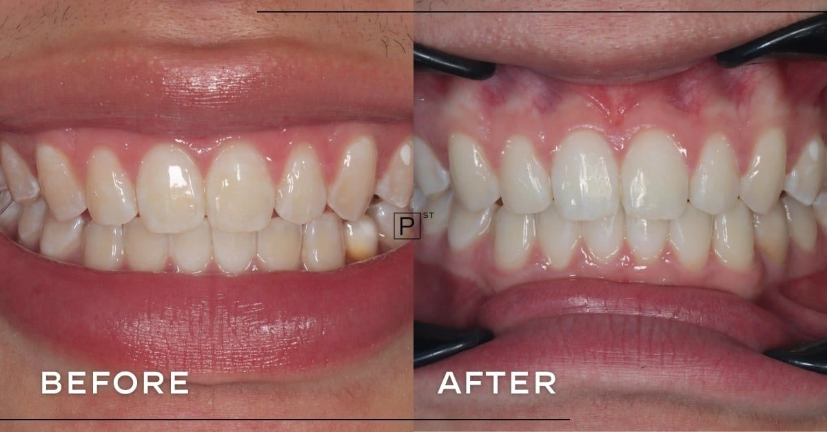 Victor of Sydney CBD’s Invisalign and Porcelain Veneer Makeover Gallery image