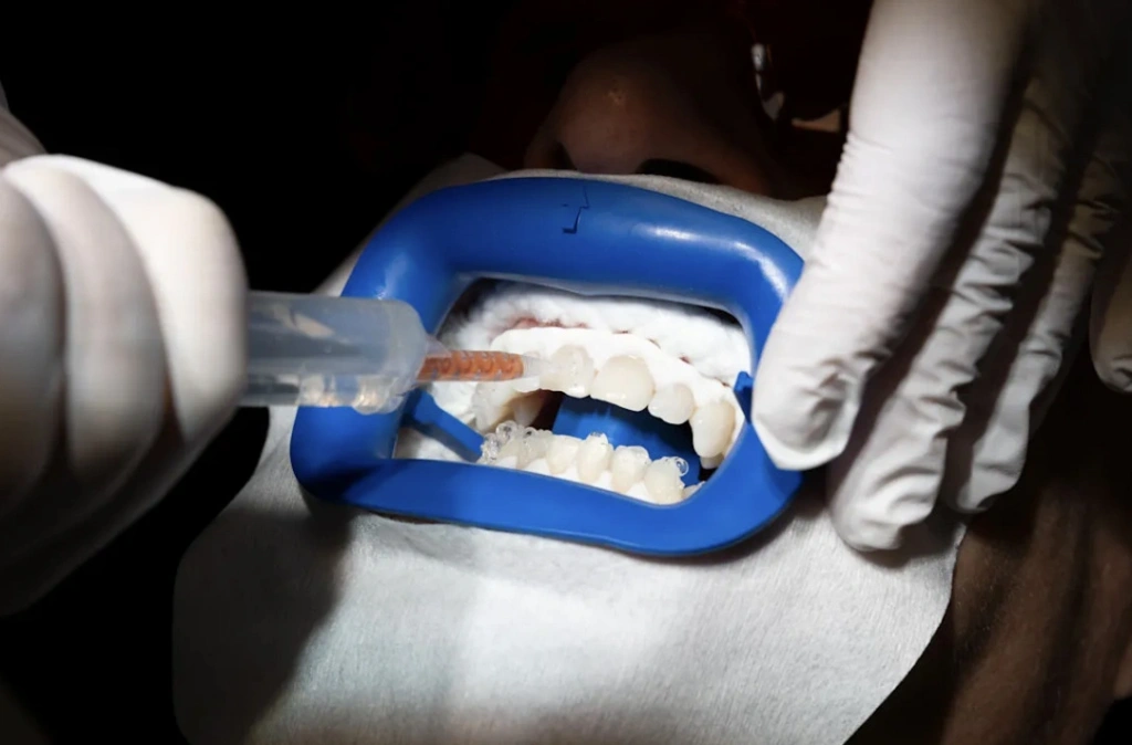 With the gums and mouth shielded, the active ingredient is applied: hydrogen peroxide. JANIE BARRETT
